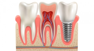 Faster, Easier, Better: The Advantages of Same-Day Implants