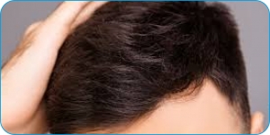 Regain Your Hair & Confidence: DHI and MHI Hair Transplants Explained