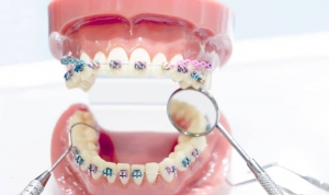 Can Adults Get Braces? Orthodontists Say Yes!