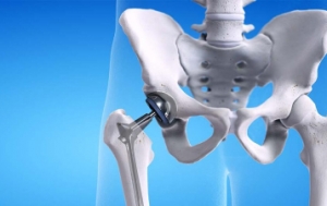 Regain Mobility and Comfort with Hip Joint Replacement Surgery in Pune