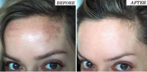 The Impact of Pollution on Melasma in Islamabad and How to Manage It