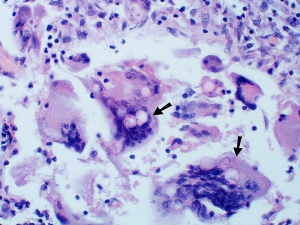 Blastomycosis Treatment Market to Witness High Growth Owing to Pharmaceutical Innovations