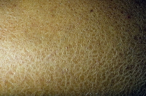 Lamellar Ichthyosis Market to Grow with Gene Therapy Solutions
