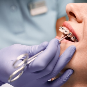 How Much Are Braces? Breakdown of Costs for Metal, Ceramic, and Invisalign