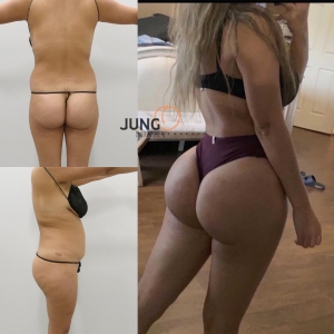 Belly Fat Removal Surgery: A Complete Guide to Tummy Tucks and Beyond