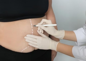 How to Choose the Best Abdominal Liposuction Surgeon: Expert Tips