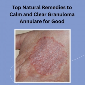 Top Natural Remedies to Calm and Clear Granuloma Annulare for Good