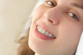 What Are Clear Aligners and How Do They Work?