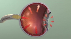 Open-Angle Glaucoma Drugs Market to Grow Rapidly on Drug Delivery