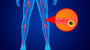 Peripheral Arteral Disease Market Will Grow at Highest Pace Owing to Innovative Therapeutics