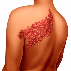 Varicella Zoster (HHV-3) Infections Market is driven by Vaccine Innovations