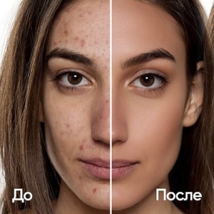 Understanding Hormonal Acne and How to Manage It