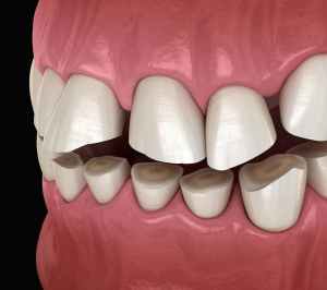 How Do Dentists Treat Chronic Bruxism?