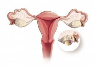 Vulvar Cancer Drugs Market to Surge on Immunotherapy Breakthroughs