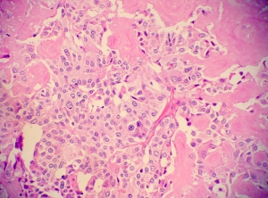 Medullary Thyroid Cancer Drugs Market to Grow with Innovative Therapies