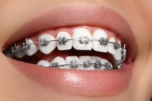 How Often Should You Visit the Orthodontist with Braces?