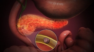 Acute Pancreatitis Market to Soar Due to Treatment Innovations 