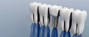 Ready for a Smile You Can Be Proud Of? Dental Implants Are the Way