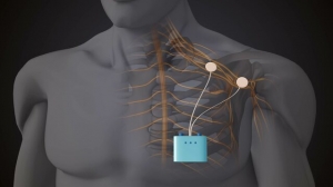 Peripheral Nerve Stimulators Market Will Grow at Highest Pace Owing to Rising Chronic Pain Prevalence