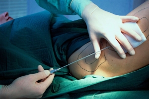 Affordable Liposuction in Islamabad: Tips to Save Money
