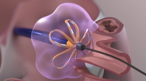Cardiac Ablation Devices Market to Grow on AI-driven Mapping