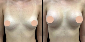 Best Doctors in Dubai Share Tips for Preparing for Breast Augmentation Surgery