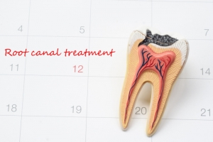 What to Expect After a Root Canal: Day-by-Day Recovery
