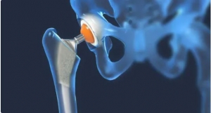 Hip Replacement Surgery in Nagpur
