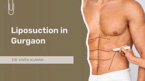 Discover the Best Liposuction in Gurgaon: Reshape Your Confidence