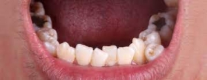Are Overlapping Teeth Considered a Dental Problem?