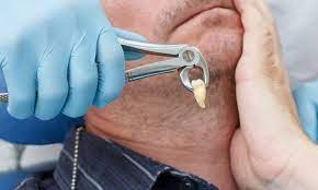 What Are the Common Complications After Wisdom Tooth Surgery?