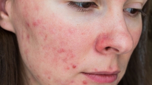 Acne Treatment for Stubborn Pimples That Just Won’t Go Away