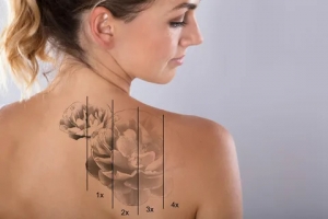 Affordable Laser Tattoo Removal Clinics in Islamabad