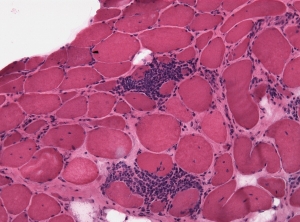 Inflammatory Myositis Diagnosis Market to Grow Rapidly Owing to Biomarker Innovations