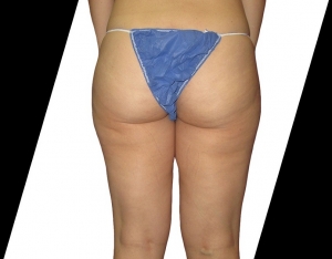 Can Liposuction Treatment Help You Achieve Your Body Goals?