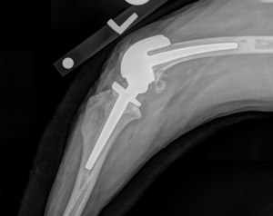 Knee Replacement Cost in Lahore: Everything You Need to Know