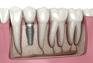 Enjoy Eating and Smiling Again with Comfortable Dental Implants