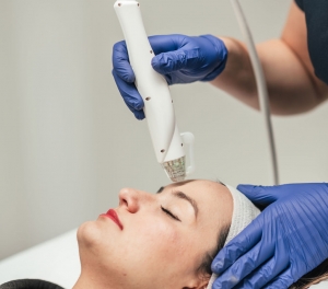 Fractional RF Microneedling: Perfect for Acne Scar Reduction