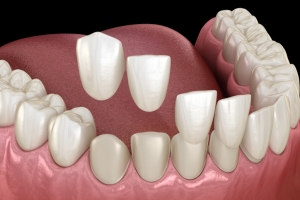 When veneers look fake?