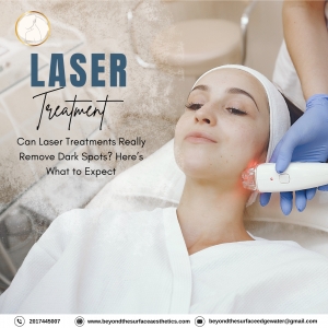 Can Laser Treatments Really Remove Dark Spots? Here’s What to Expect