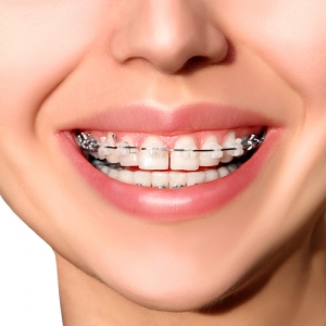 How Often Will I Need Adjustments with Metal Braces?