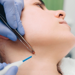 Which is better for mole removal?