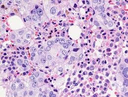 Metastatic Prostate Cancer Market to Grow Due to Targeted Therapies