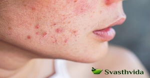 Effective Ayurvedic Solutions for PCOS: 5 Natural Treatments That Deliver Results