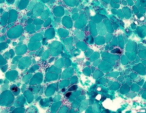 Inclusion Body Myositis Market to Soar Owing to Rising R&D Investment