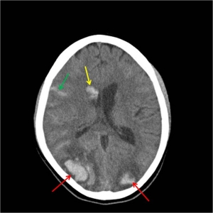 Intracranial Hemorrhage Diagnosis Market to Surge Owing to Imaging Innovations