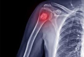 What to Expect from Bone Cancer Treatment in Lahore