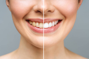 Five Justifications For Getting Toronto Teeth Whitening Treatment