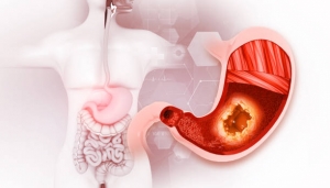 Gastric Balloon in Riyadh: Affordable Weight Loss Solution