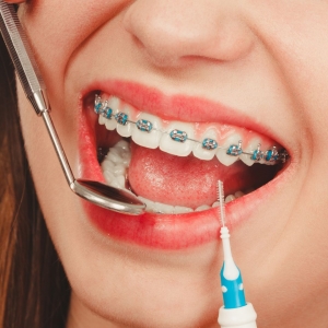 10 Things to Know About Braces Cost in Australia Before Starting Treatment